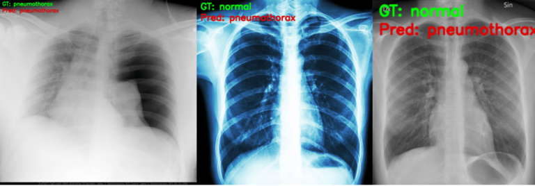 Pneumothorax Binary Classification using PyTorch Model Pretrained on ...